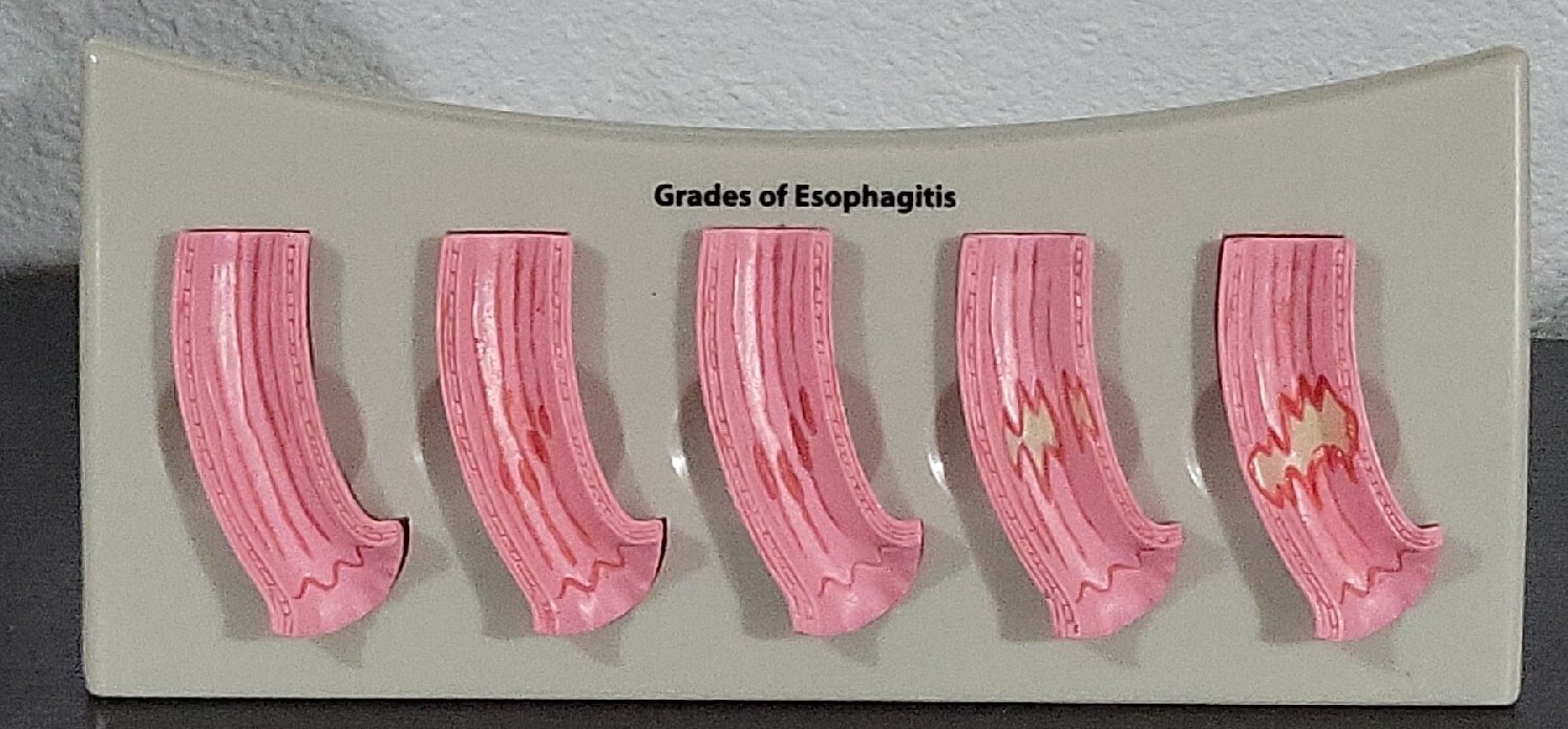 Vtg Prevacid Lansoprazole Doctor Pharmaceutical Display Grades Of Esophagitis