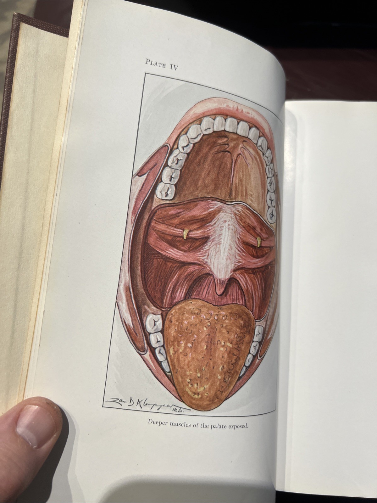 RARE Oral Surgery 1915 Illustrated Medical Dentistry Disease Truman W Brophy