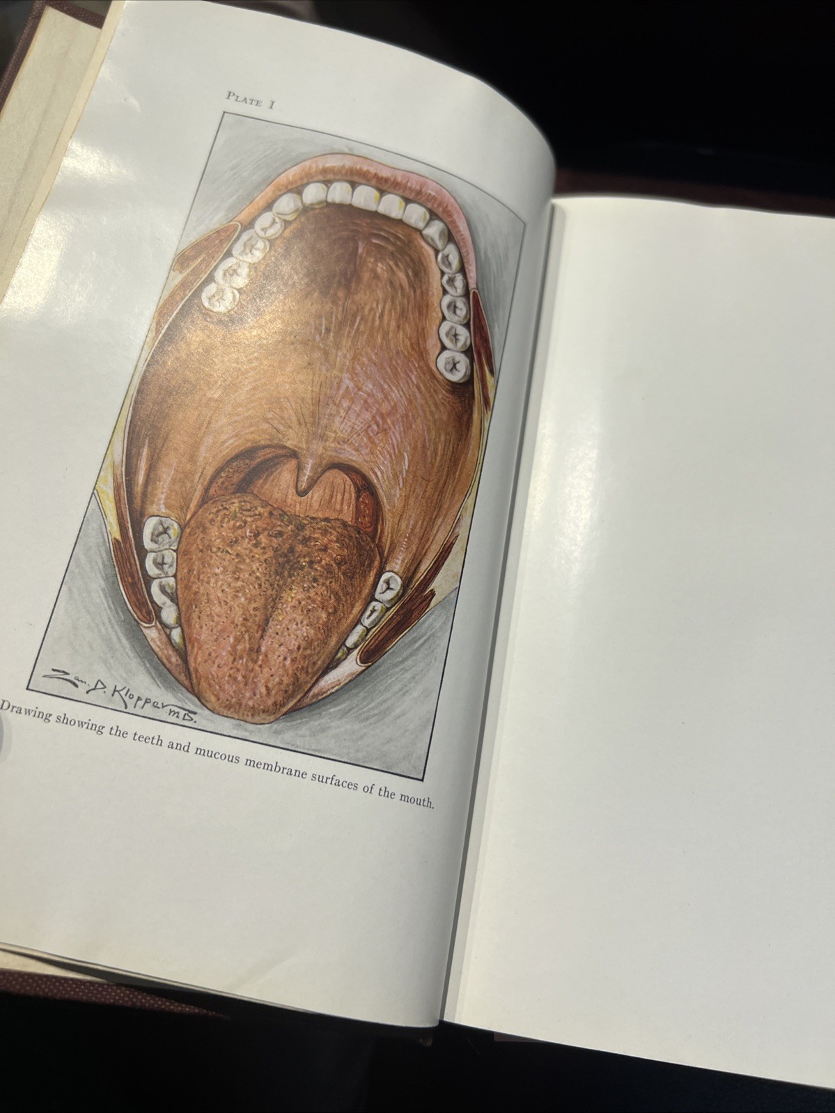 RARE Oral Surgery 1915 Illustrated Medical Dentistry Disease Truman W Brophy