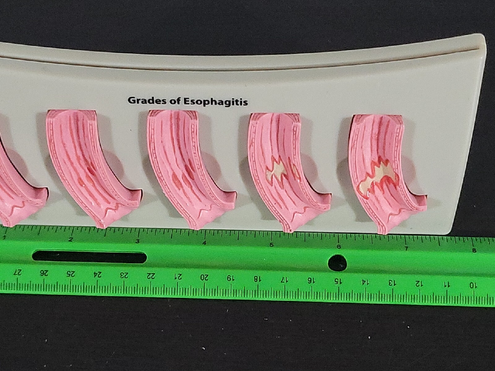 Vtg Prevacid Lansoprazole Doctor Pharmaceutical Display Grades Of Esophagitis